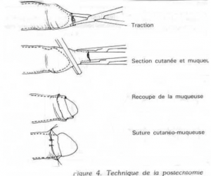 circoncision